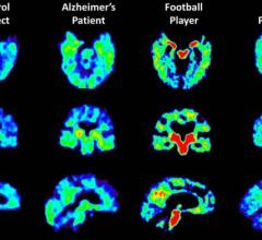 Abnormal Protein Concentrations Found in Brains of Military Personnel With Suspected CTE