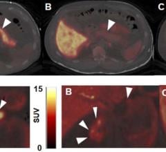 Novel PET Imaging Method Could Track and Guide Type 1 Diabetes Therapy