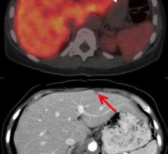 Axial fused 89Zr-5B1 antibody PET/CT image demonstrates focus of uptake in the liver (arrow). Focus of uptake correlates with increased liver metastasis seen on diagnostic CT (red arrow) performed 2 weeks prior