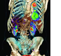 radiotracer, cancer imaging, diagnostics, PET, 18F-FLT