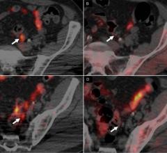 In scans of a 62-yr-old man with Gleason 4+3 PCa treated with radical prostatectomy, with rising PSA level (1.32) and PSA doubling time of 3.7 months, 64CuCl2-PET/CT images revealed 2 positive small left iliac lymph nodes (A,C), whereas 18F-Choline PET/CT (B,D) was negative (arrows).