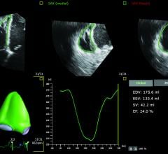 3D Auto RV application image courtesy of Philips Healthcare