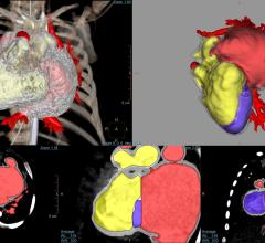 Philips IntelliSpace Portal 10 Highlighted by New 3-D Modeling Application