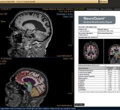 NeuroQuant Software Compatible With Hitachi 1.2T, 1.5T and 3.0T Hitachi MRI Scanners