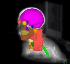 Philips Collaborates With MIM Software on Radiation Therapy Treatment Planning