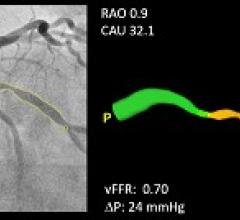 FAST Study Demonstrates High Diagnostic Accuracy of CAAS vFFR