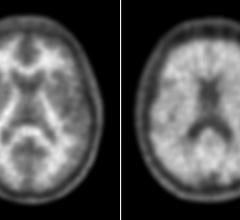 New Data Presented on Neuraceq Amyloid Plaque Imaging Agent at SNMMI 2014