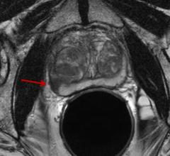 Prostate cancer, MRI, restriction spectrum imaging, RSI-MRI, novel, detection