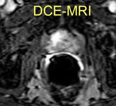 BPH, prostate, interventional radiology, PAE, embolization, SIR