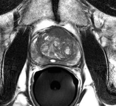 Radiation therapy, ASTRO, clinical trial/study, prostate cancer