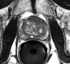 intermediate-risk prostate cancer, brachytherapy versus external beam therapy, radiation therapy, RT, ASTRO 2016