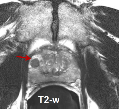 Prostate Cancer Czech Proton Therapy Center Diagnosis Treatment