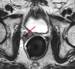 prostate cancer UCL study