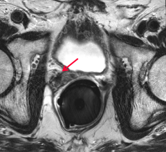 recurrent prostate cancer, hormone therapy, radiation therapy, Cedars-Sinai study, New England Journal of Medicine