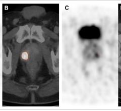 PSMA PET-CT Clearly Differentiates Prostate Cancer from Benign Tissue