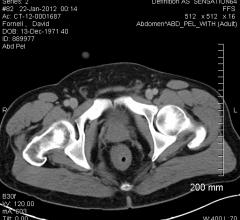 prostate cancer, ProtecT trial findings, ASTRO 2016, radiation therapy