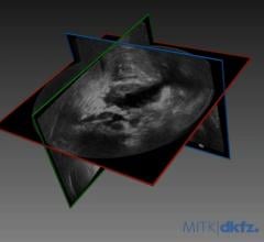 New Module Creates a Warped MRI Scan that Matches Real-Time Ultrasound Results (Graphic: Business Wire)