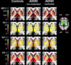 imaging MRI systems rsna 2013 adhd