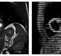 Rapid Cardiac MRI Technique May Cut Costs, Boost Care in Developing World