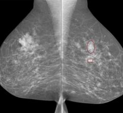 Overweight Women May Need More Frequent Mammograms