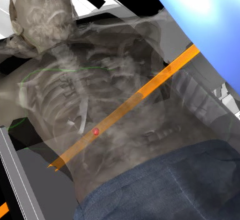 Surgery and High-Dose SBRT Radiation Can Be Combined to Treat Kidney Cancer