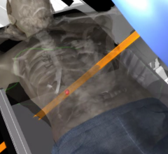 radiation therapy need, developing countries, IAEA study, International Atomic Energy Agency, ASTRO 2016