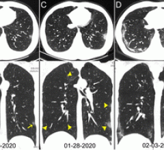 In a study of more than 1,000 patients published in the journal Radiology, chest CT outperformed lab testing in the diagnosis of 2019 novel coronavirus disease (COVID-19) #COVID19 #COVID-2019 #2019nCoV #COVID-19