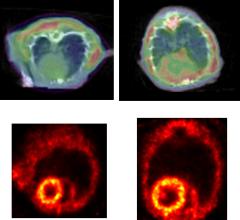 PET Imaging Shows Protein Clumping May Contribute to Heart Failure Development