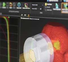 First Clinical Monte Carlo Photon Dose Planning Conducted in RayStation