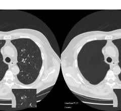 SimonMed Deploys ClearRead CT Enterprise Wide