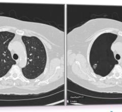 Researchers Use Radiomics to Predict Who Will Benefit from Chemotherapy