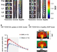 PET, neuroinflammation, multiple sclerosis, MS, Adam Rosenberg, SNMMI 2016