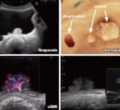 New Technology Enables Enhanced Blood Flow Visualization With Ultrasound