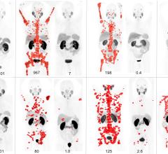 SNMMI Image of the Year Highlights Theranostic Approach for Advanced Prostate Cancer