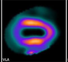 Dual-isotope imaging: reduced-dose, shorter-scan-time stress images acquired with 20 mCi Tc-99m at 10 sec/frame. Photo courtesy of Mayo Clinic.