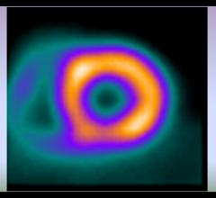 Large Nuclear Cardiology Laboratory Slashes Radiation Dose 60 Percent in Eight Years