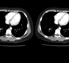 Radiation dose management, RSNA 2014, CT systems, Comprehensive dose strategy