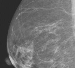 mammography systems women's healthcare imaging rsna 2013 tomosynthesis