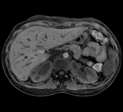 mri software rsna 2013 systems siemens starvibe mr twise-vibe quiet suite