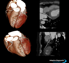 rsna 2013 ct systems toshiba adaptive technology aquilion prime one edition