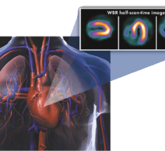 The Ultraspect xpress.cardiac nuclear imaging solution reduced SPECT radiation dose. 