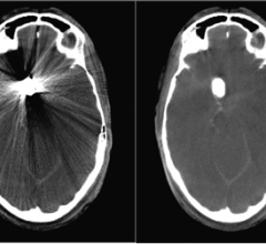 New Siemens Angiography Apps Enhance Diagnostic Capability