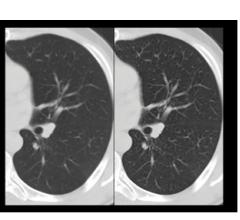 CT systems, Lung Cancer, ClearCT Lung, U.S. Centers for Medicare & Medicaid