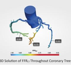 HeartFlow, CT-FFR, computed tomography fractional flow reserve, UH Case Medical