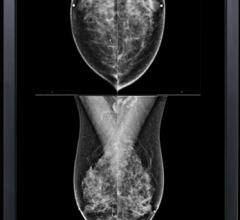 Computer-aided detection breast, mammography, women's health, M-Vu CAD