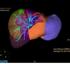 Successful Diagnostic Oncology Exams With Ingenuity CT