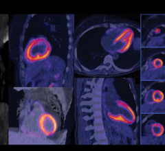 Researchers Trace Parkinson’s Damage in the Heart