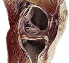 Siemens Healthineers Introduces GOKnee3D MR Application