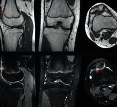 FDA Clears Siemens Healthineers' GOKnee3D MRI Application