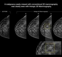 An example of breast tomosynthesis 3-D mammography detection of lesion.